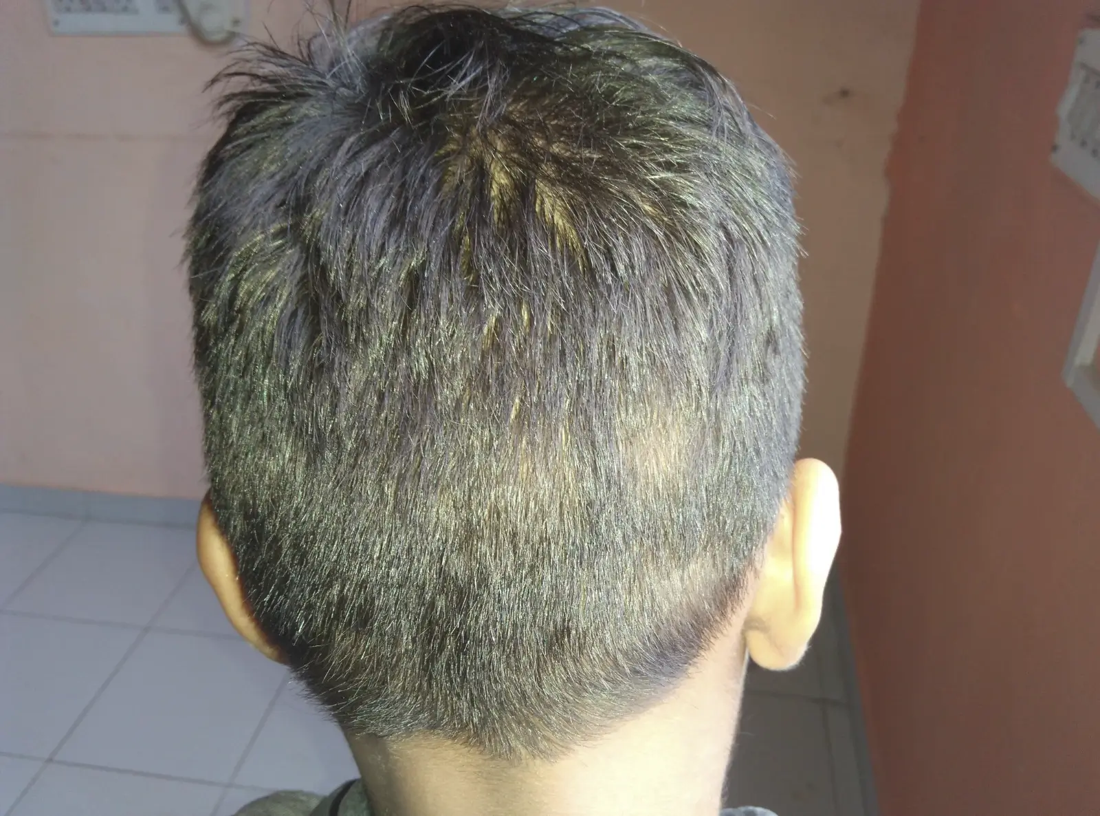 Alopecia Areata case 4 after treatment